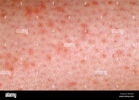 Idiopathic Thrombocytopenic Purpura Rash