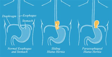 Esophagus Hiatal Hernia Surgery