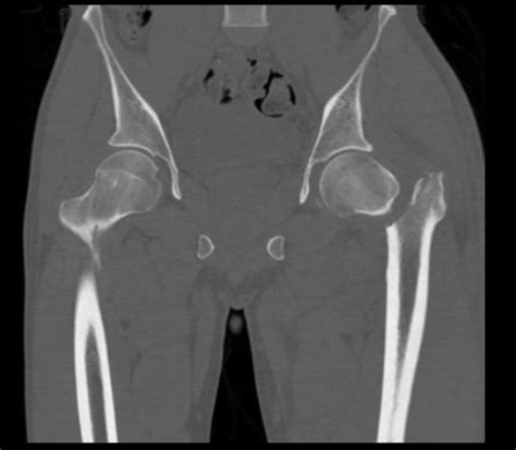 Intertrochanteric Fracture