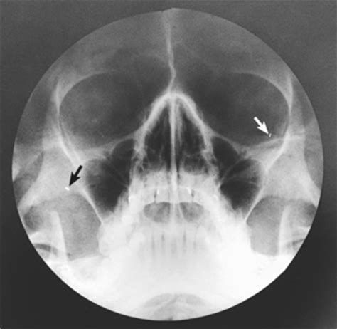 PARANASAL SINUSES | Radiology Key