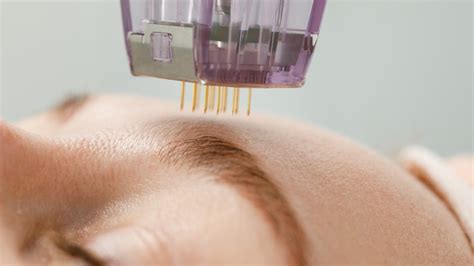 Mesotherapy What To Know About The Do It All Injection Procedure