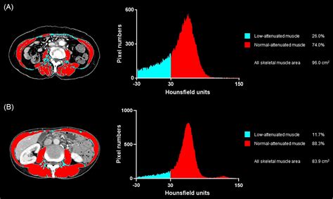 Frontiers Impact Of Baseline Muscle Mass And Myosteatosis On The