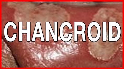 What is Chancroid Or Soft Chancre? Early signs, Symptoms and Causes of ...