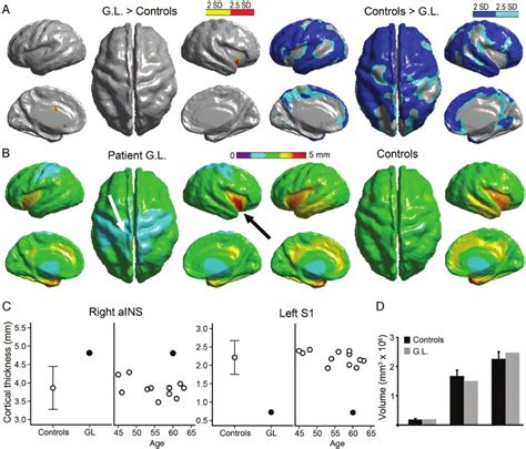 Altered Cortical Thickness With Preserved Brain Gm Wm And Csf