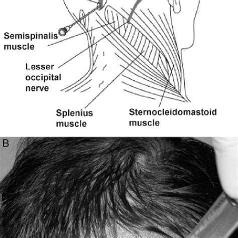 Occipital Nerves Block A This Diagram Illustrates Greater Occipital Download Scientific