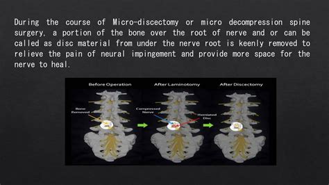 PPT - Get Best Treatment by Microdiscectomy Surgery in India PowerPoint ...