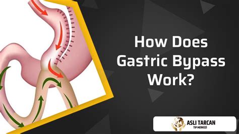 How Does Gastric Bypass Work