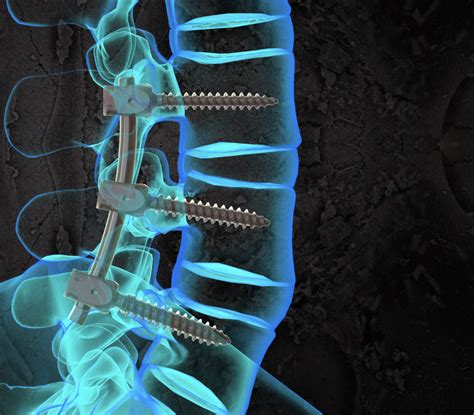 Posterior Lumbar Fusion