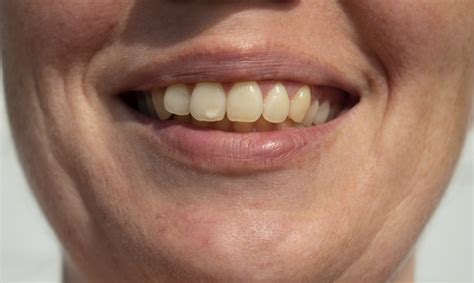 Different Types Of White Spots On Teeth And What They Mean Hancock