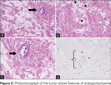 Figure 3 From Giant Renal Angiomyolipoma Masquerading As A Wilms Tumor