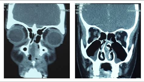 An Unusual Case Of Nasal Septal Hematoma Caused By Local Dental