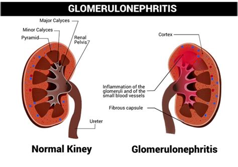 Glomerulonephritis Symptoms