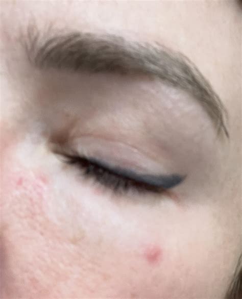 Red Bumps Around Eye R Skincareaddicts