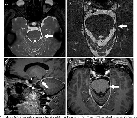 Figure From A Case Of Trochlear Nerve Schwannoma Presenting With