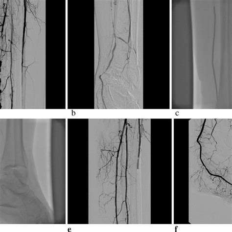 Pdf Endovascular Reconstruction Of Popliteal And Infrapopliteal Arteries For Limb Salvage And