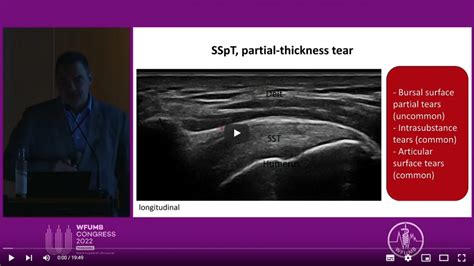 Ultrasound In Rotator Cuff Lesions From Diagnosis To Treatment ~ Plamen Todorov Bulgaria Wfumb