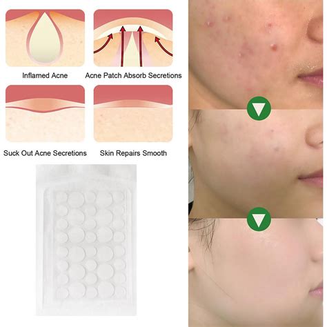 Acne Patch Hydrocolloidwater Gel Invisible Concealer Patch Remove