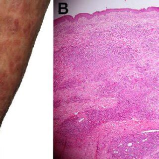 Granulomatous Mycosis Fungoides A Clinical Features Demonstrate