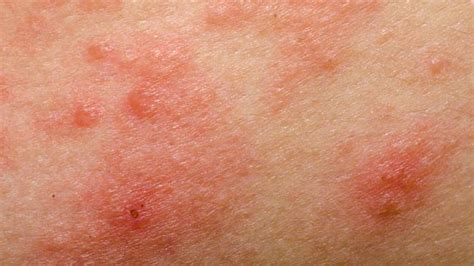 Allergic Eczema Causes Symptoms And Diagnosis