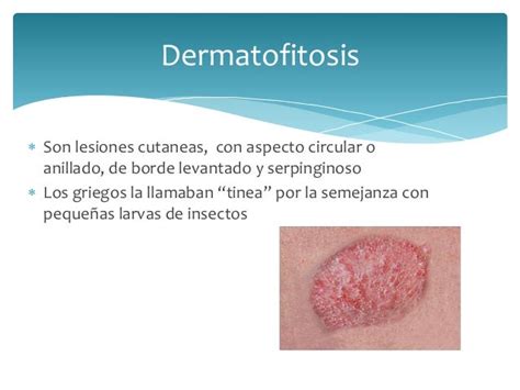 Micosis Superficiales Y Cutaneas Pdf Piel Enfermedades Y Trastornos Images