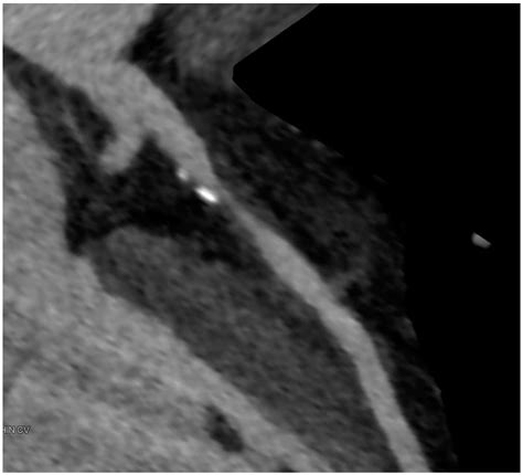 Ijms Free Full Text Coronary Ct Angiography In Managing Atherosclerosis