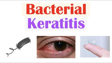 Keratitis Symptoms And Causes