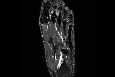 Smartspeed Forefoot Imaging Philips Mr Body Map