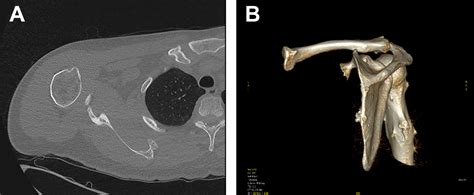 Ventral Scapular Osteochondroma In Hereditary Multiple Exostosis