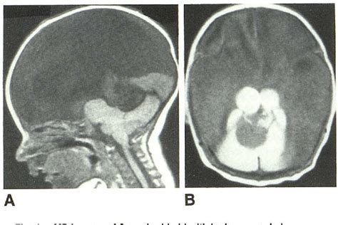 Figure 1 From Mr Of Hydranencephaly Semantic Scholar