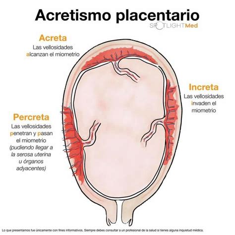 Acretismo Placentario I A M Obstetricia Enfermer A Obstetricia