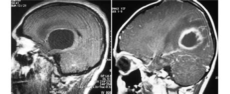 Sagittal T1 Weighted Mr Images Obtained In Different Patients After