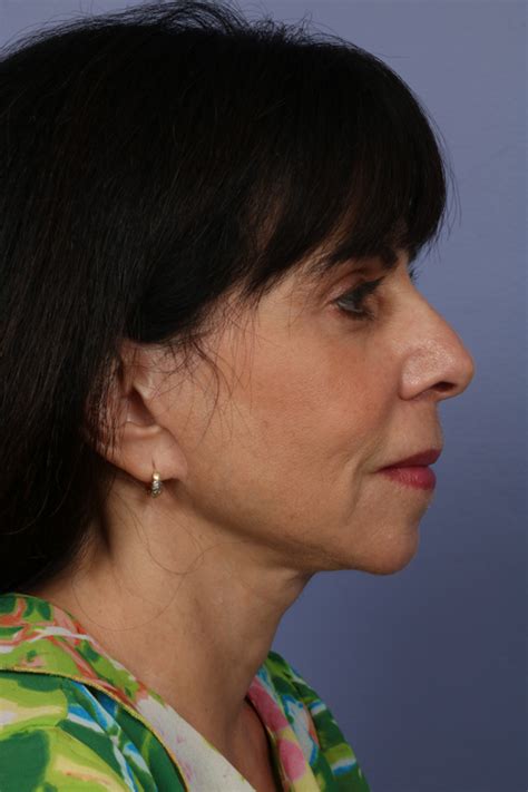 Los Angeles Facelift Before And After Photos Beverly Hills Plastic