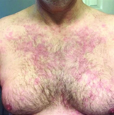 Urticarial Like Rash On The Chest Of The Patient Download Scientific Diagram