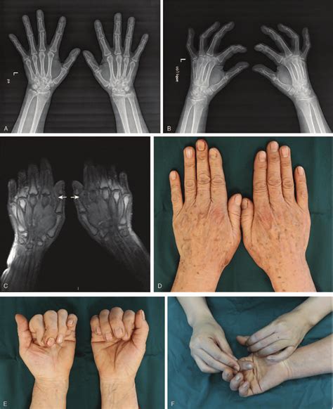 Metacarpophalangeal Joint Dislocations ScienceDirect 41 OFF