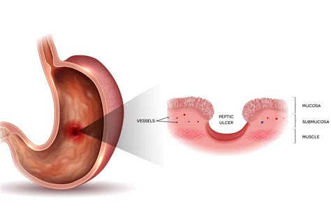 Tukak Lambung Penyebab Gejala Diagnosis Dan Pengobatan