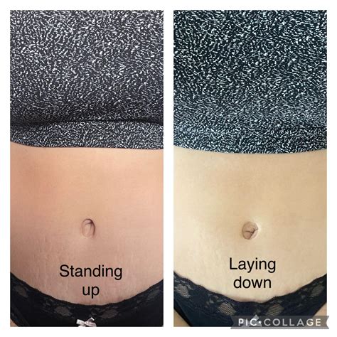 Did My Bellybutton Get Botched After Tummy Tuck R Plasticsurgery