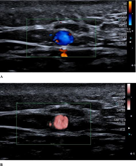 Temporal Artery Ultrasound To Diagnose Giant Cell Arteritis A Practical Guide Ultrasound In