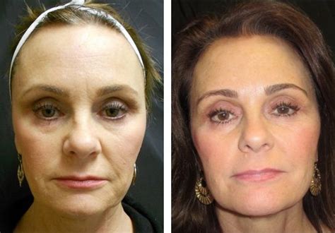 Ultherapy Lift Before And After Fairfax And Washington Dc