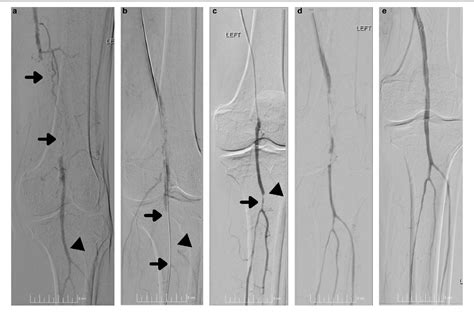 Figure From Extended Use Of Distal Embolic Protection Devices In