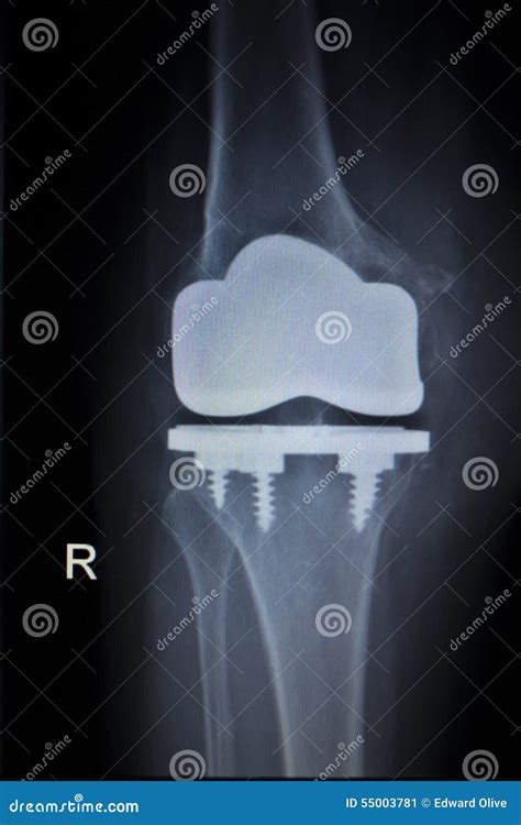 X Ray Orthopedics Scan Of Knee Meniscus Implant Prosthetics Stock Image