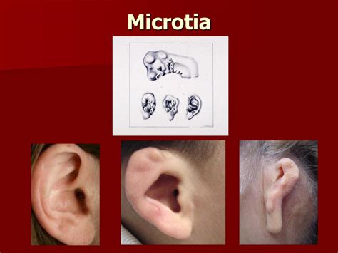 PPT - CONGENITAL AURAL ATRESIA PowerPoint Presentation, free download - ID:1226644