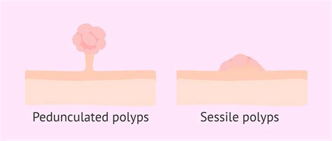 Types Of Endometrial Polyps Sessile And Pedunculated