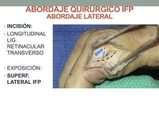 Abordajes Quirurgicos Interfalangica Proximal Dedo Pptx