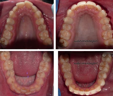 Cambios En Las Arcadas Dentales De La Paciente Antes Y Despu S De