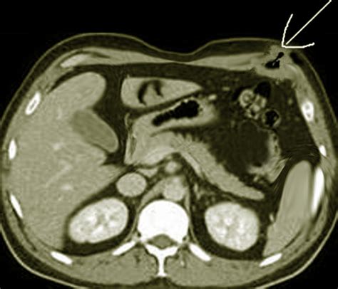 Richter Hernia Statpearls Ncbi Bookshelf