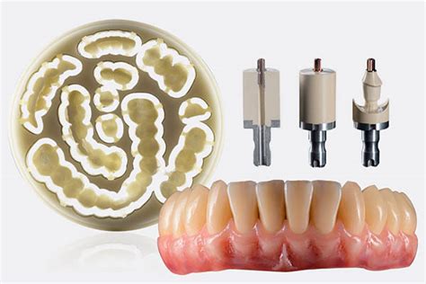 Coronas Dentales De Zirconio Ventajas Y Desventajas Resycam Todo