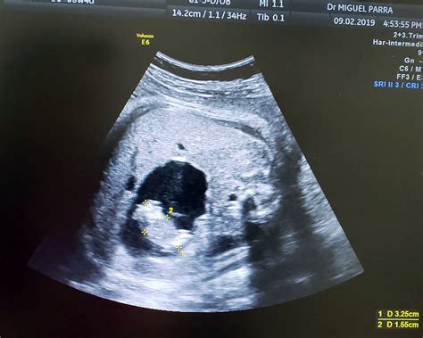 21 Weeks Pregnant With Twins Ultrasound