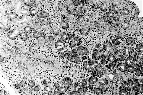 One Day After Reperfusion Abundant Diffuse Inflammatory Infiltrate