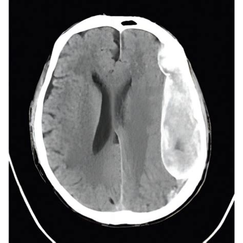 A C Show The Soft Tissue Windows Of The Emergency Axial Head Ct Download Scientific Diagram