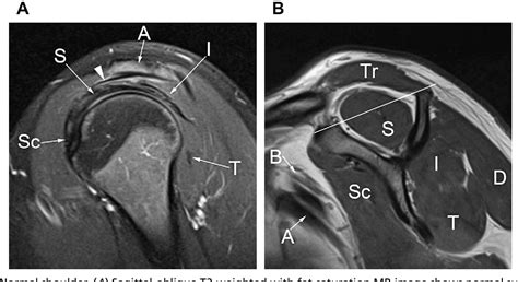 Sagittal Shoulder Mri Anatomy